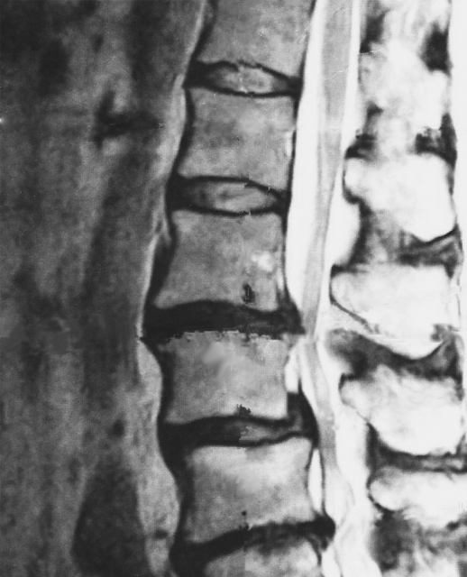 脊柱管狭窄症の診断画像