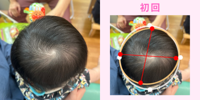 短頭症（絶壁）施術前の頭の画像