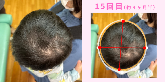 短頭症（絶壁）施術後（１５回目）の頭の画像