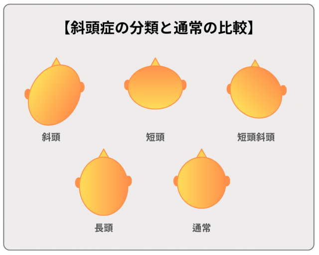 斜頭症の分類と通常の頭の形の比較